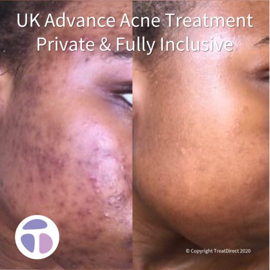Young black woman with severe acne before Roaccutane treatment, and with clear skin after Isotretinoin therapy.
