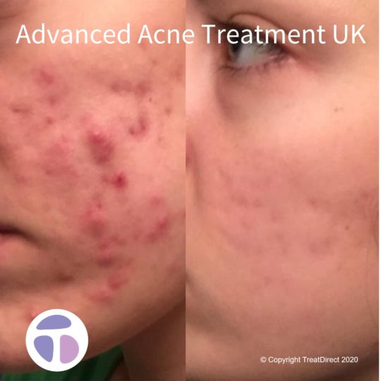 Photo of female before and after Roaccutane treatment