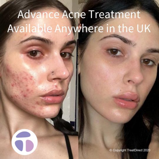 Mid-20s woman before & after Roaccutane medication. Severe pustular acne on cheeks before, beautifully clear skin after.