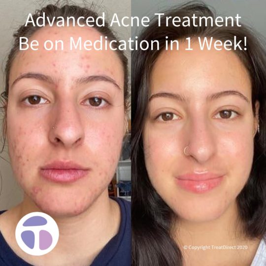 Woman with moderate to severe acne before and after Roaccutane medication. Acne present on full face before, complete acne cure after.