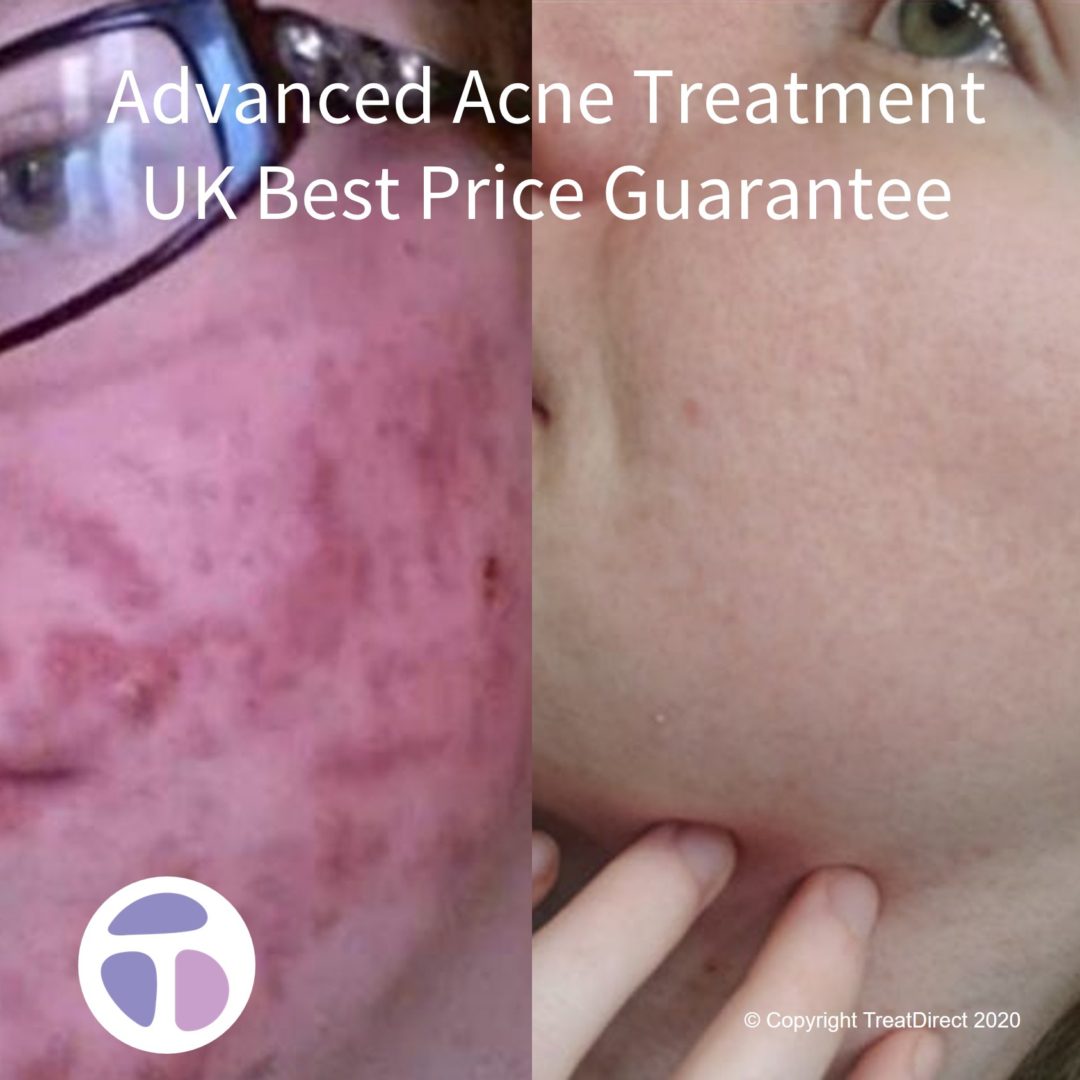 Face of Roaccutane patient before and after treatment. Red, spotty skin is now smooth and clear of acne.