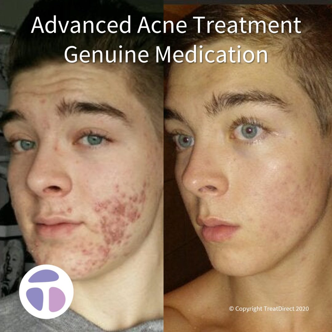 Young white man with pustular inflammatory acne before and nearly perfect skin after Roaccutane therapy.
